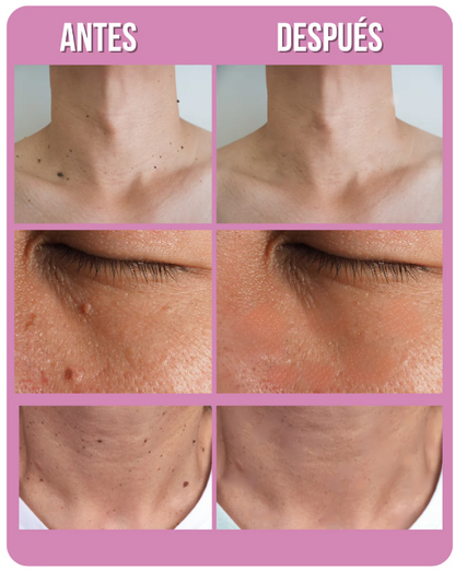 Luminiix Verrugas OFF – Eliminador Natural de Verrugas Sin Dolor